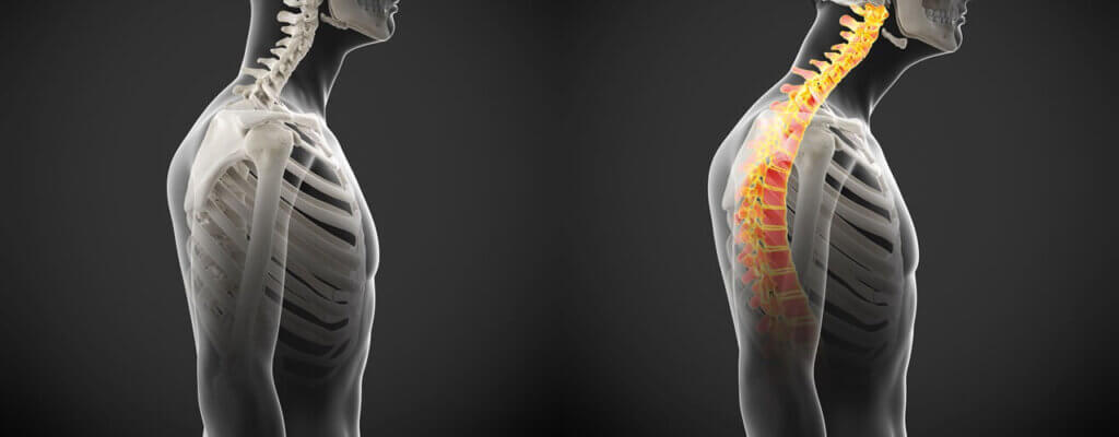 Understanding_Postural_Dysfunction_Causes_Effects_and_Physical_Therapy_Solutions