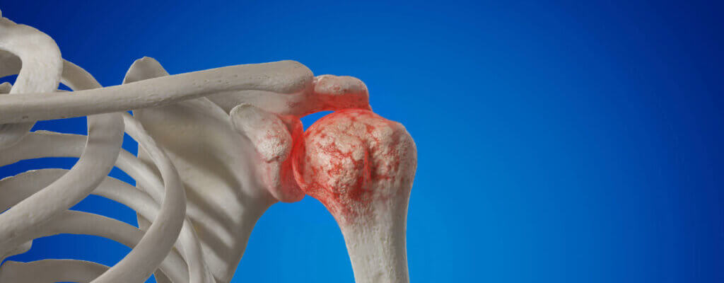 Arthritis in the Shoulder Joint solution in Florida